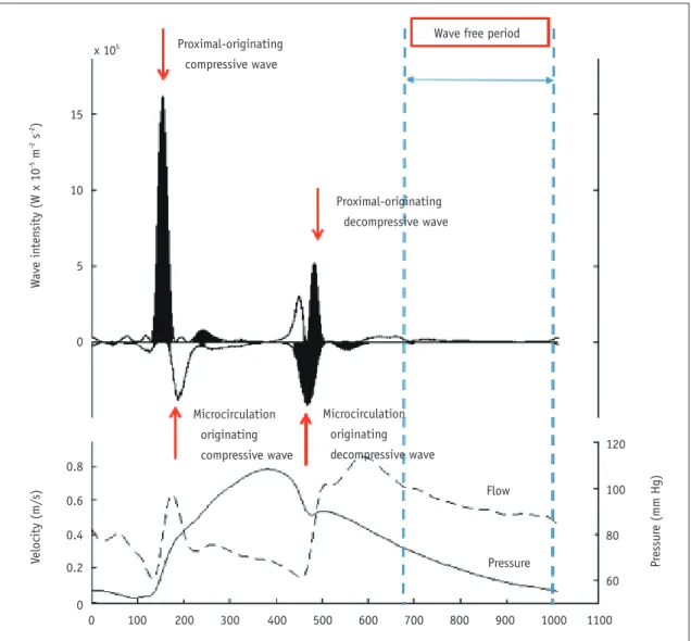 Fig. 5. Wave intensity analysis and concept of instantaneous wave-free ratio (iFR).  Upper panel shows example of wave intensity  analysis