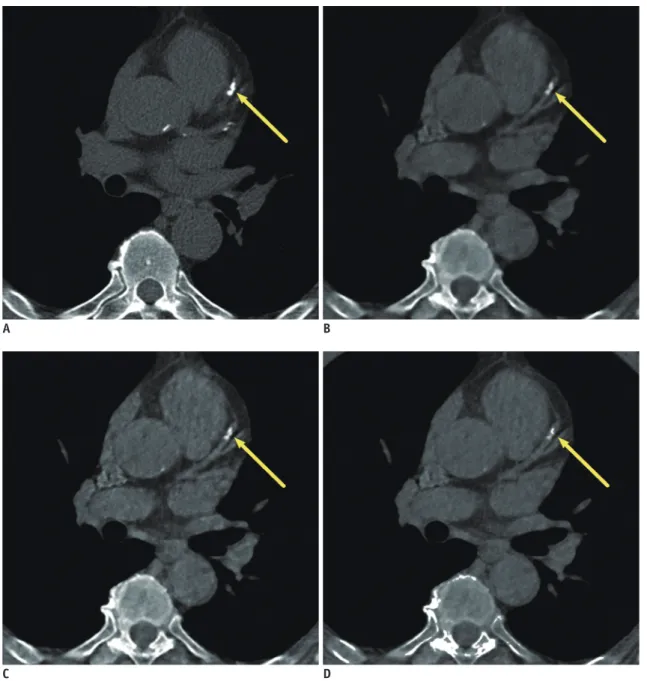 Fig. 1. Reconstructed images of corresponding axial 2.5-mm sections of heart in 70-year-old man.