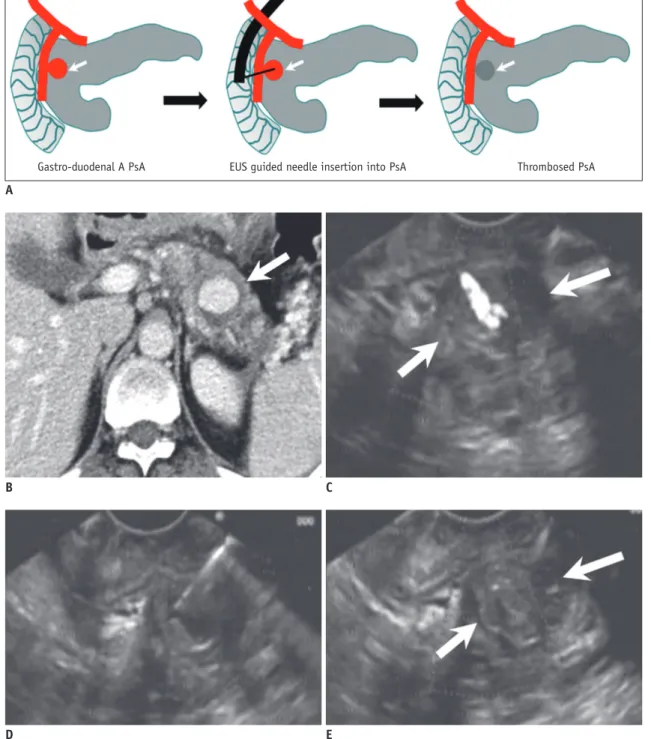 Fig. 10. EUS guided thrombin injection. 27-year-old male patient with pancreatitis, presenting with hematemesis