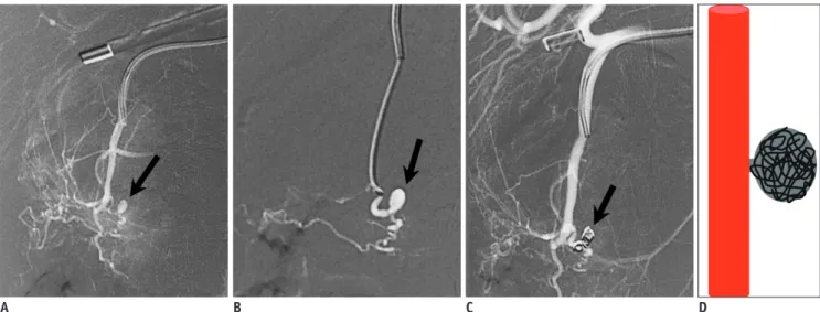 Fig. 4. Sac packing. 42-year-old male patient with acute pancreatitis, presenting with hematemesis and hemodynamic instability.