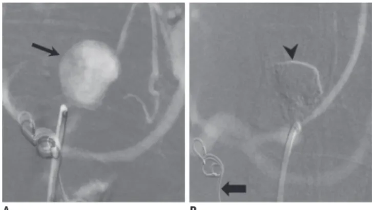 Fig. 8. Other techniques: schematic diagram illustrating stent graft placement (A), stent assisted coiling (B), and balloon  remodelling (C) techniques