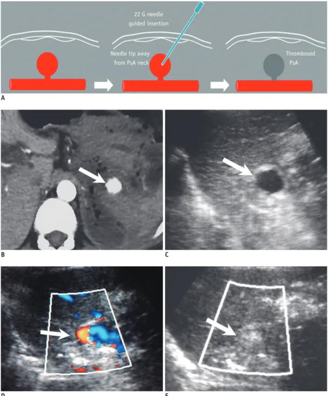Fig. 9. Percutaneous approach for pseudoaneurysm embolization. 34-year-old female patient with pancreatitis, presenting with  hemodynamic instability