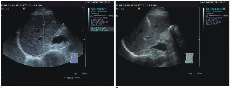 Fig. 1. Acoustic radiation force impulse, ARFI (A) and liver biopsy (B) were performed in same tissue area (segment eight of  right lobe)