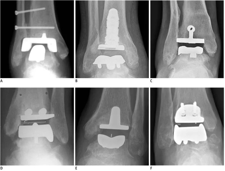 Fig. 1. Total ankle arthroplasty devices.