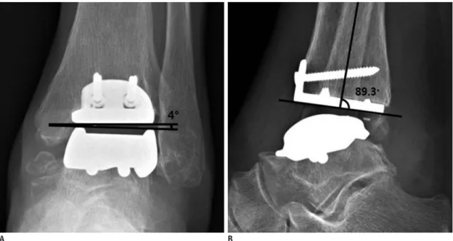 Fig. 2. Normal appearance of total ankle arthroplasty (TAA) as seen on radiography.