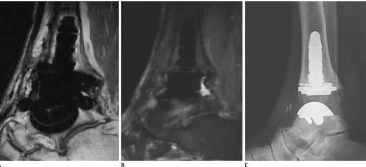 Fig. 4. Normal appearance of total ankle arthroplasty (TAA) as seen on magnetic resonance imaging.