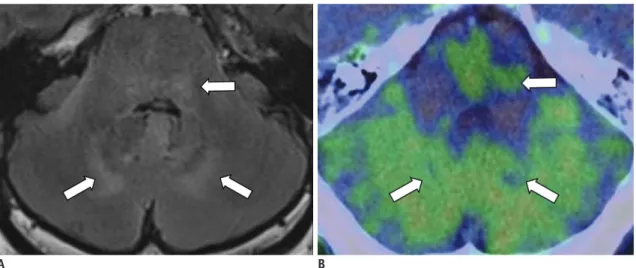 Fig. 3. 76-year-old man with brain tumor. 