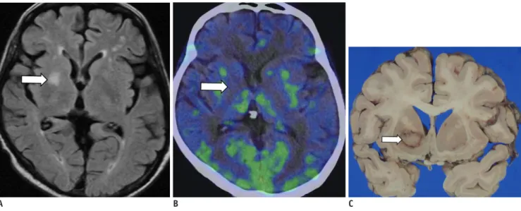 Fig. 7. 56-year-old man with recurrent leukemia after chemotherapy.