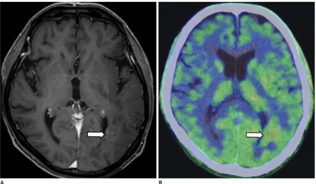 Fig. 14. 64-year-old man with tumefactive demyelination in post-treatment state.