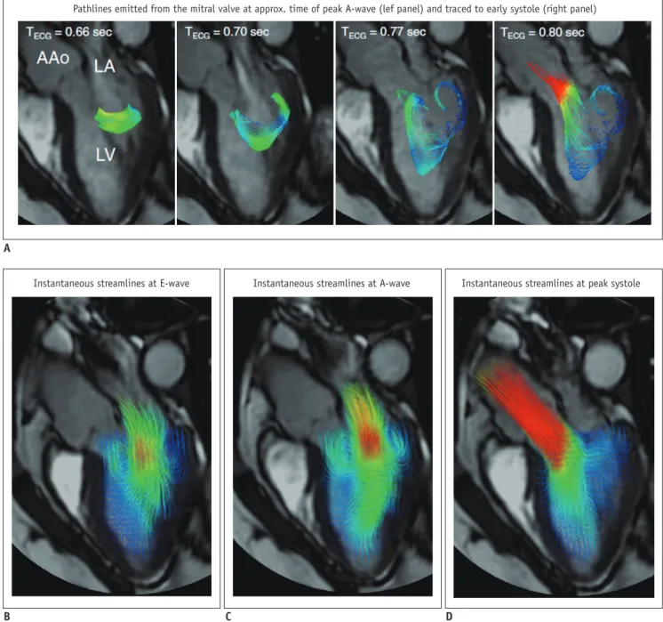 Fig. 8. Examples of 4D flow cardiac magnetic resonance visualization techniques, demonstrated on intracardiac flow data acquired  in healthy volunteer