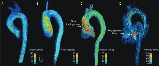 Fig. 10. Comparison of patients with normal (A) and abnormal  (B) prosthetic valves.  Inset panels indicate opening of prosthetic  valves