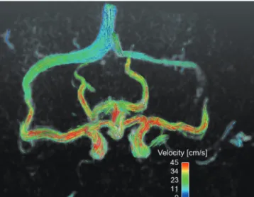 Fig. 13. Turbulent kinetic energy (TKE) estimation using 4D PC-MRI. 