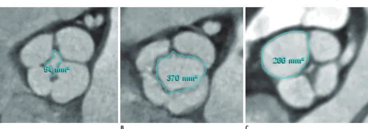 Fig. 2. Classification of quadricuspid aortic valve according to  Hurwitz and Robert’s classification