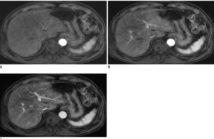 Fig. 2. Triple arterial phase (TAP) of 80-year-old man with colon cancer. 