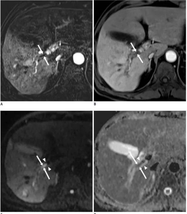 Fig. 3. Bland thrombosis of portal vein in 65-year-old man without underlying disease.