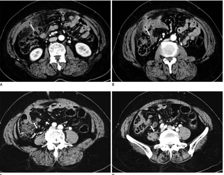 Fig. 1. 62-year-old female presented with right lower quadrant pain one year after laparoscopic cholecystectomy.