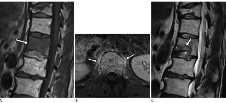 Fig. 13. Acute compression fracture with bone marrow edema mimicking infection. 