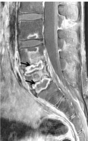 Fig. 1. Pyogenic discitis.  9-year-old girl received chemotherapy for  leukemia. Sagittal fat-suppressed, contrast-enhanced T1-weighted  image showed peripheral rim enhancement (arrows) of L4–5 and L5–S1  discs.