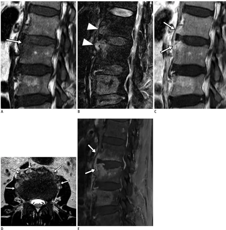 Fig. 2. Pyogenic (enterococcal infection) spondylodiscitis. 