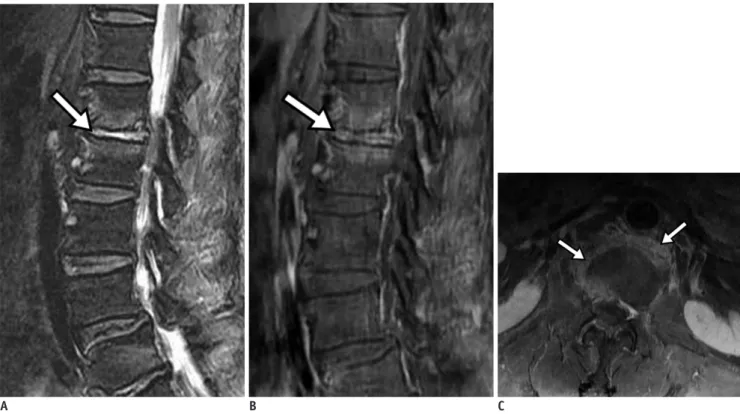 Fig. 3. Pyogenic spondylodiscitis. 