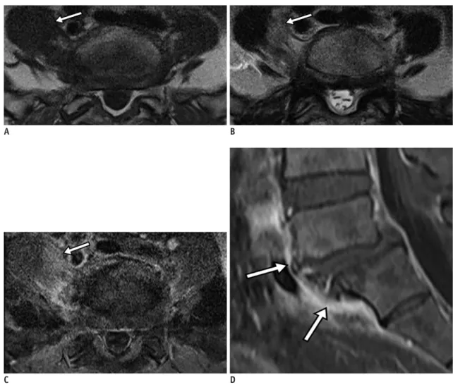Fig. 5. Pyogenic spondylodiscitis. 