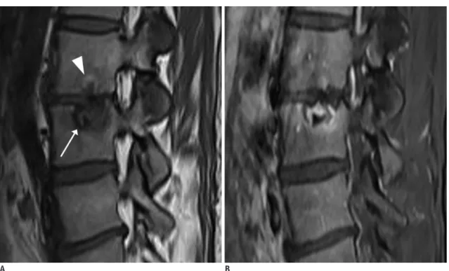 Fig. 8. Acute Schmorl’s node. 