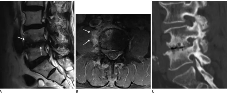 Fig. 9. Type 1 Modic change. 