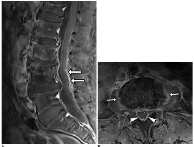 Fig. 11. Pyogenic (staphylococcal infection) spondylodiscitis. 