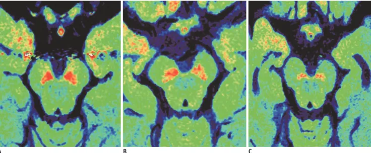 Fig. 2. Differences for SN between PDD, AD and control subjects in neuromelanin-sensitive T1-weighted imaging.