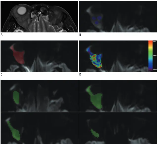 Fig. 1. Schematic illustration of three ROI selection methods on DW (b = 800 s/mm 2 ) images obtained from 70-year-old patient  with orbital lymphoma.