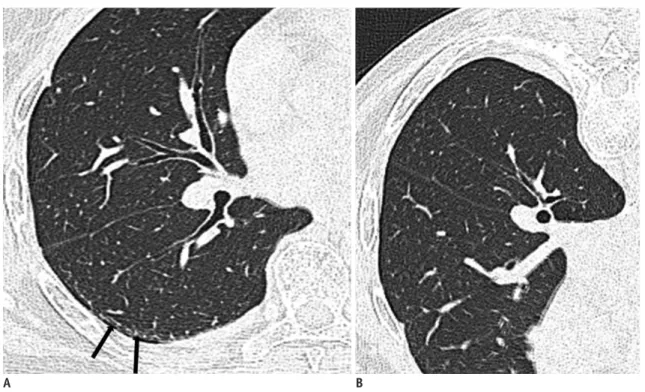Fig. 11. Dependent atelectasis in patient with history of asbestos exposure.