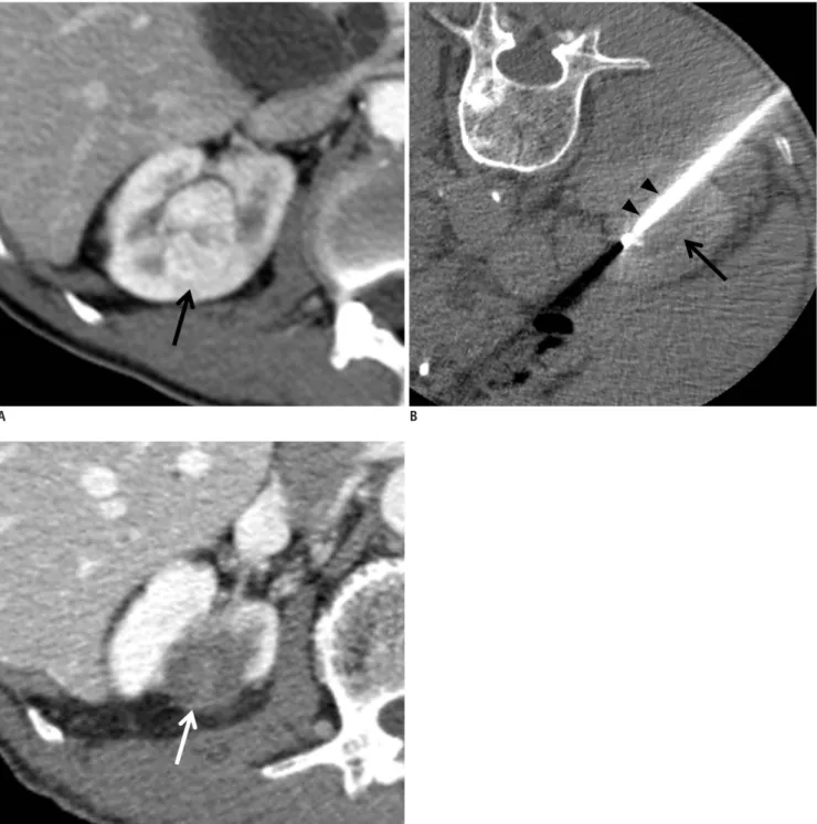 Fig. 1. 67-year-old man with clear cell RCC.