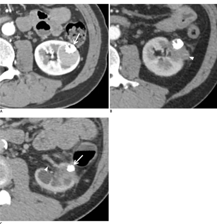 Fig. 2. 48-year-old man with clear cell RCC.
