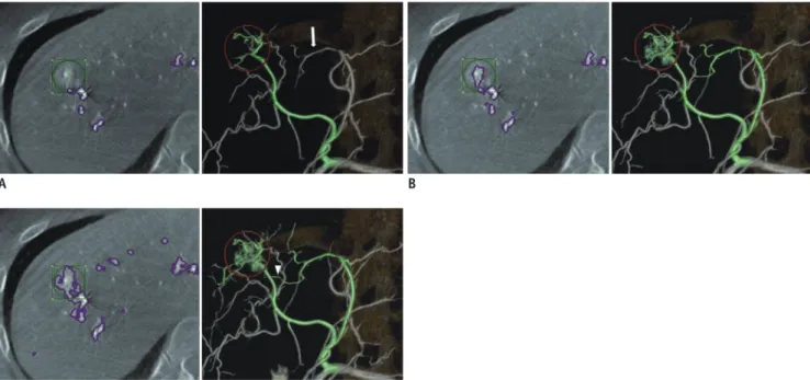 Fig. 2. Impact of three settings of FPFL software for vascular tree segmentation on accuracy.