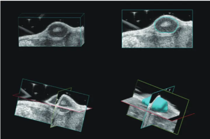 Fig. 3. Tumor volume measurement using high-resolution  three-dimensional (3D) ultrasound