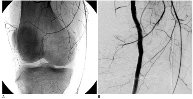 Fig. 2. Transection of right popliteal artery.