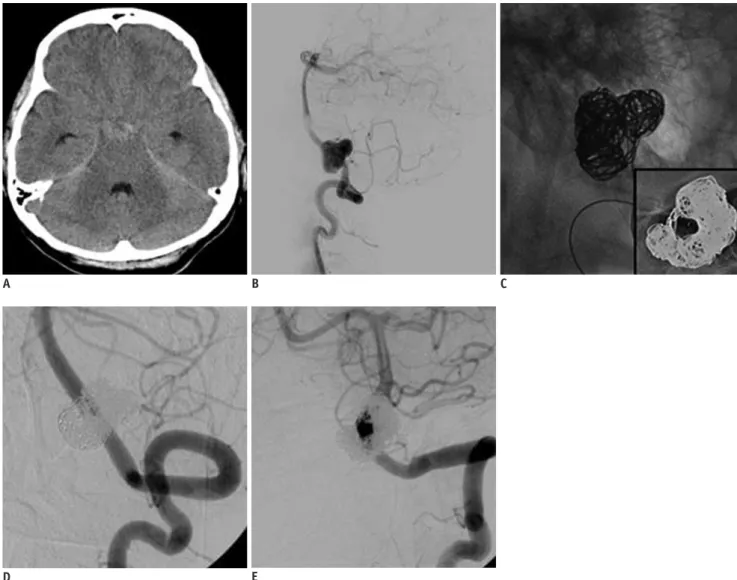 Fig. 4. Illustrative case of VBDA using down-the-barrel view.