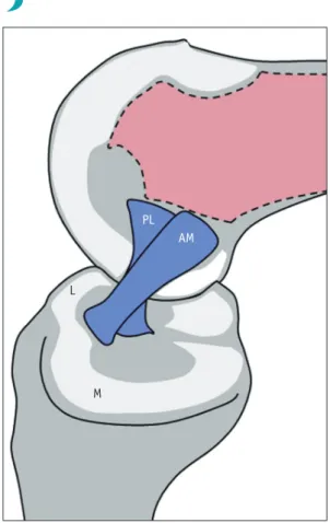 Fig. 2. Illustrations of anteroposterior view of knee showing technique for single bundle (A) and double bundle reconstruction (B)  of ACL