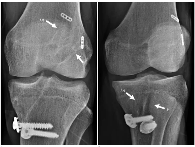 Fig. 3. Tunnel position after double-bundle ACL reconstruction reflects natural course of two ACL bundles.