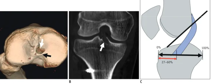 Fig. 6. Normal tibial tunnel position.