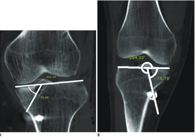 Fig. 7. Angular measurement of tibial tunnel.