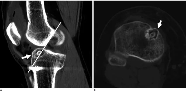 Fig. 11. Migration of button style extra-cortical fixation device. 