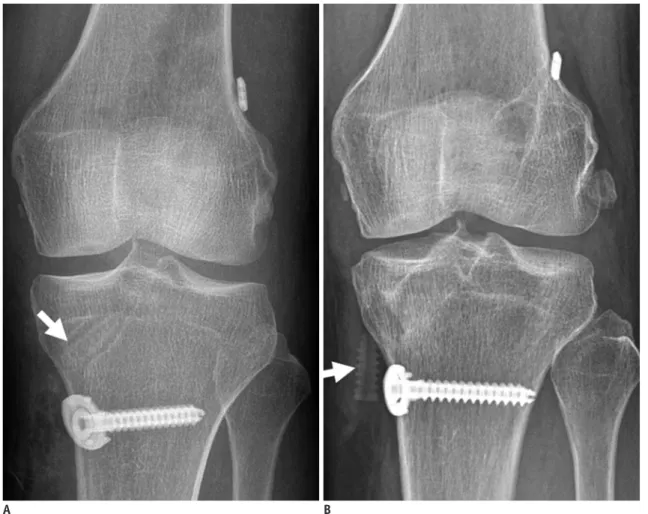 Fig. 12. Gap between fixation device and bone cortex.  On axial and coronal post-operative CT scans, gap is seen (arrows) between cortex  and fixation device, caused by tissue interposition.