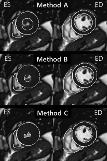 Fig. 2. Representative example of endocardial contouring  using three methods in 51-year-old man with hypertrophic  cardiomyopathy