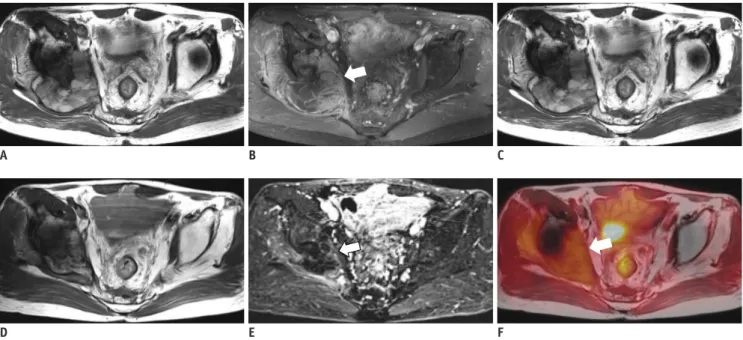 Fig. 7. 53-year-old male with radiation-induced osteosarcoma in right ilium before (A-C) and after (D-F) chemotherapy