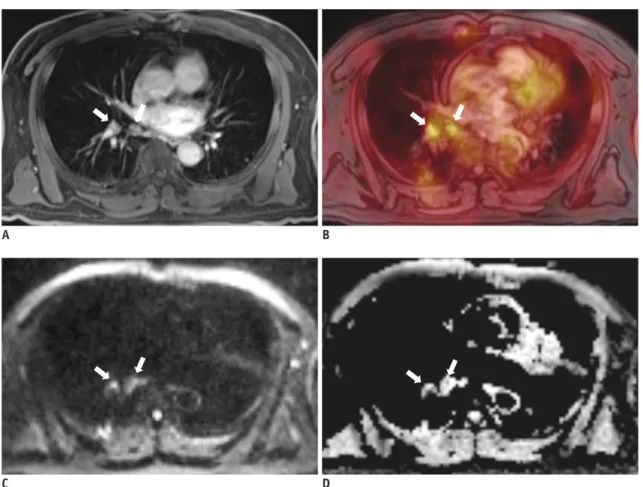 Fig. 5. 66-year-old man with 3.7-cm lung mass (not shown) in right lower lobe. 