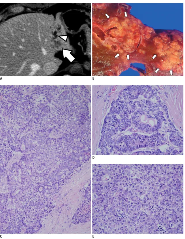 Fig. 2. Pathologically confirmed classical type of cHCC-CC.