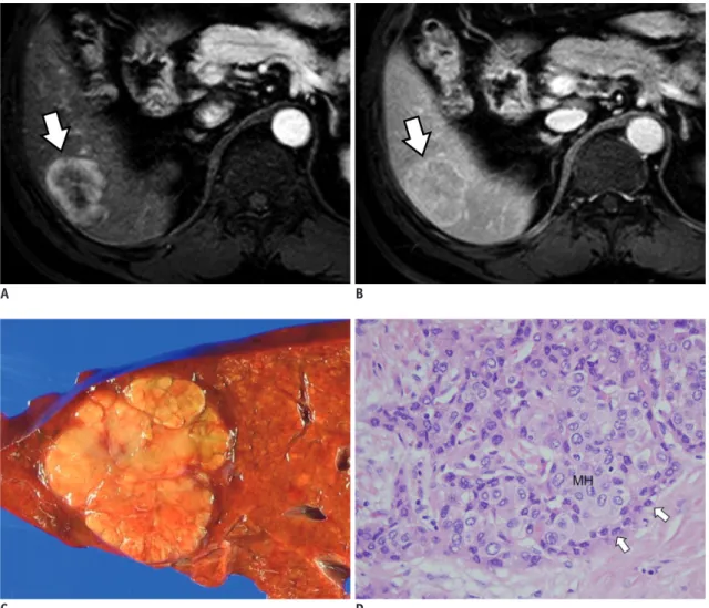 Fig. 3. cHCC-CC with stem cell features of typical stem cell subtype in 58-year-old male patient with chronic hepatitis B with  moderate elevation of serum AFP level (154 IU/mL).