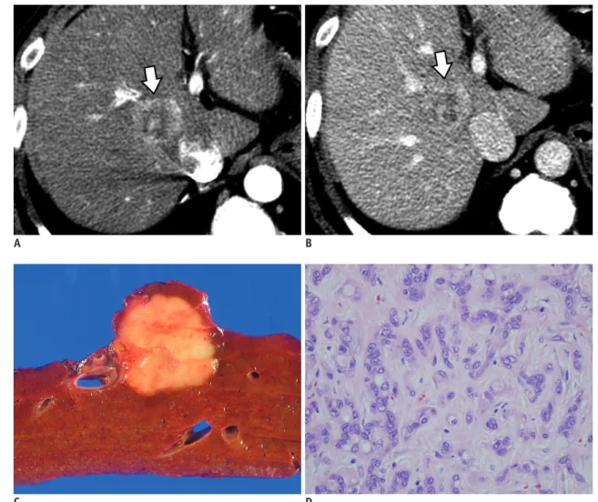 Fig. 4. Combined hepatocellular-cholangiocarcinoma with stem cell features of intermediate cell subtype in 53-year-old male  patient.