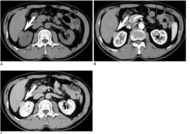Fig. 6. 43-year-old woman with small renal leiomyoma.